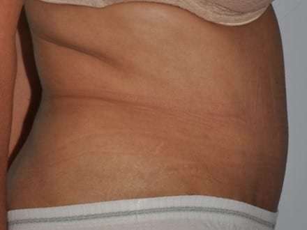 Abdominoplasty (Tummy Tuck) Before & After Patient #928