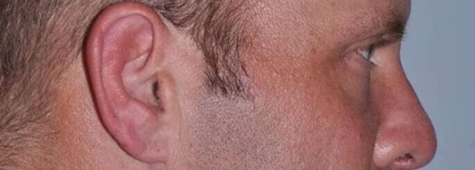 Blepharoplasty (Eyelid Surgery) Before & After Patient #4574