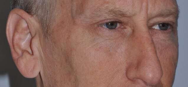 Blepharoplasty (Eyelid Surgery) Before & After Patient #4581