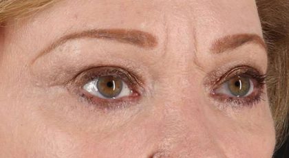 Blepharoplasty (Eyelid Surgery) Before & After Patient #4588