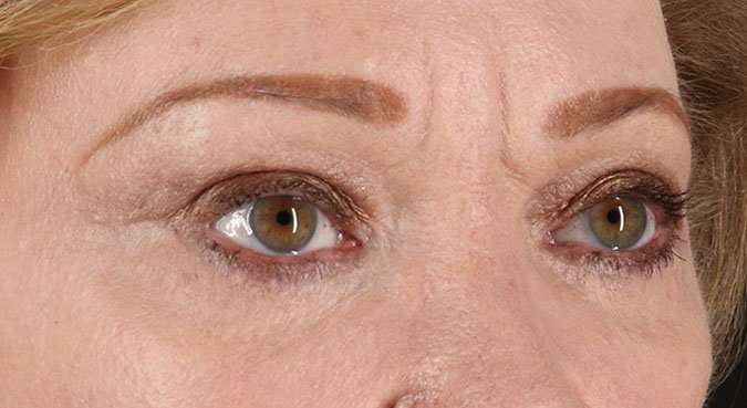 Blepharoplasty (Eyelid Surgery) Before & After Patient #4588