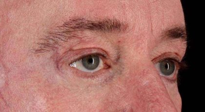 Blepharoplasty (Eyelid Surgery) Before & After Patient #4599