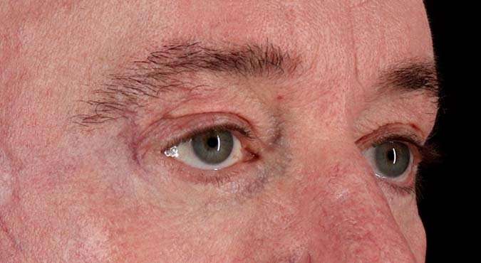 Blepharoplasty (Eyelid Surgery) Before & After Patient #4599