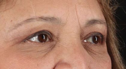 Blepharoplasty (Eyelid Surgery) Before & After Patient #4649