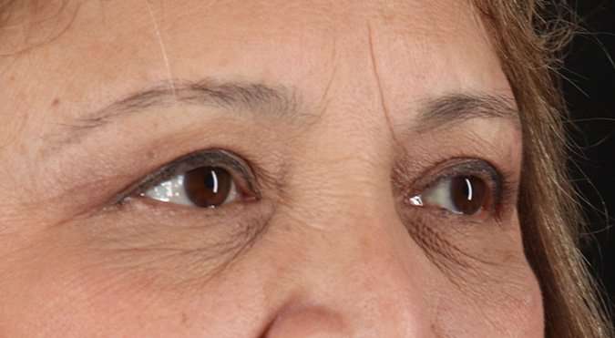 Blepharoplasty (Eyelid Surgery) Before & After Patient #4649