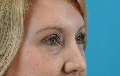 Brow Lift Before & After Patient #4672