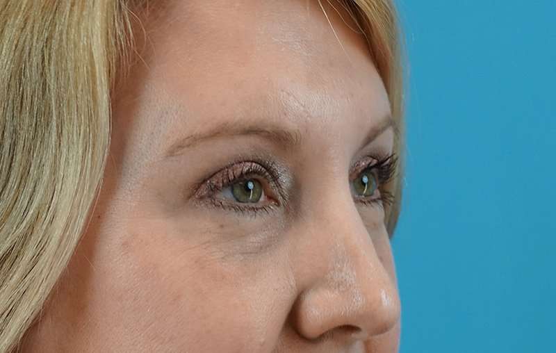 Brow Lift Before & After Patient #4672