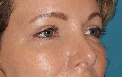 Brow Lift Before & After Patient #4679