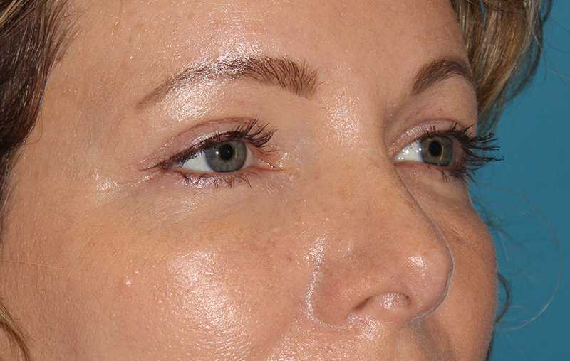 Brow Lift Before & After Patient #4679