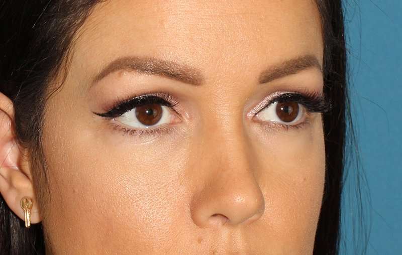Brow Lift Before & After Patient #4690