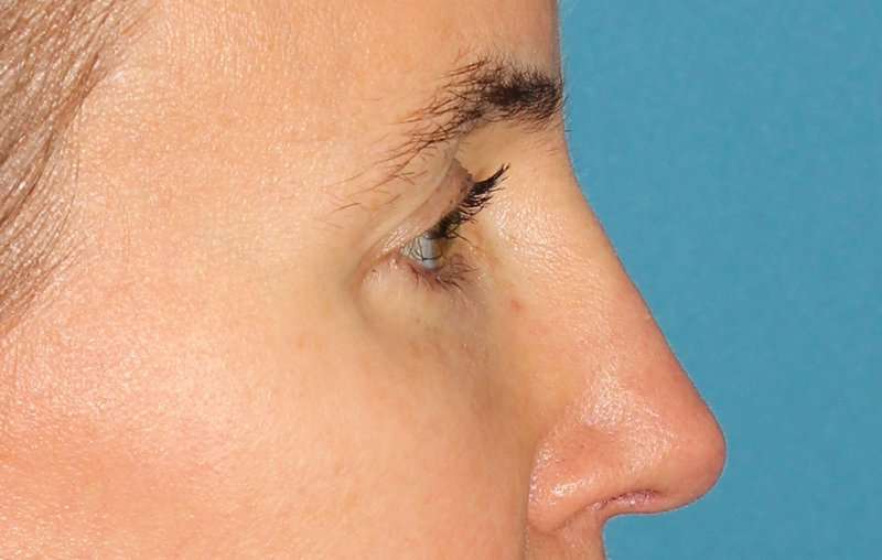 Brow Lift Before & After Patient #4697
