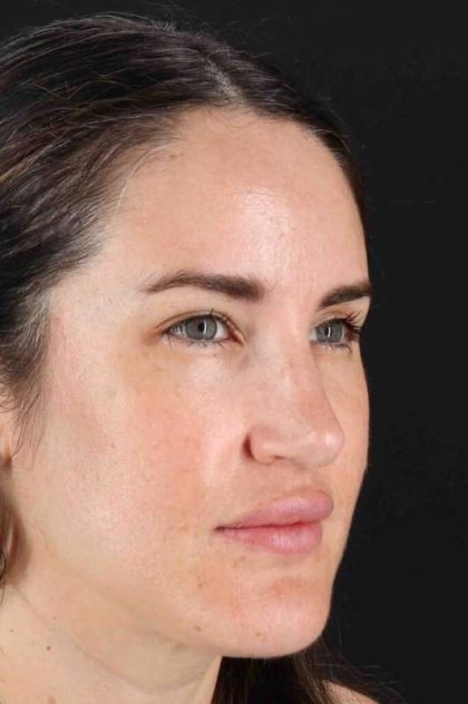 Brow Lift Before & After Patient #4711