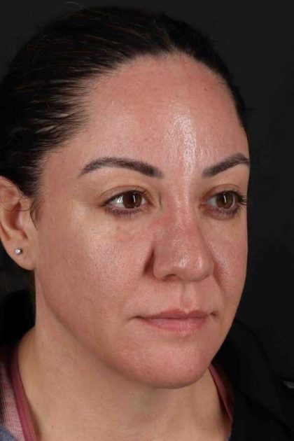 Brow Lift Before & After Patient #4733