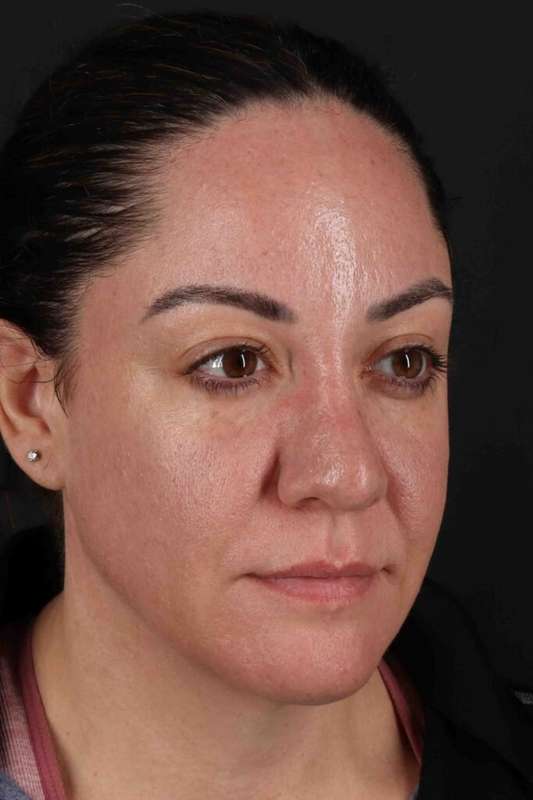 Brow Lift Before & After Patient #4733