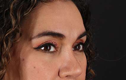 Brow Lift Before & After Patient #4744