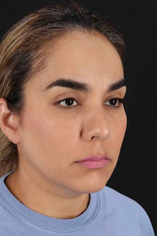 Brow Lift Before & After Patient #4755