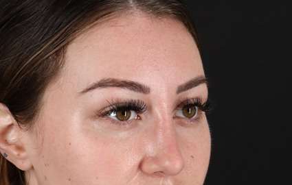 Brow Lift Before & After Patient #4766