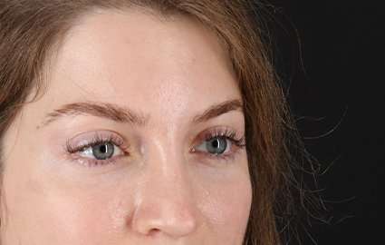 Brow Lift Before & After Patient #4777