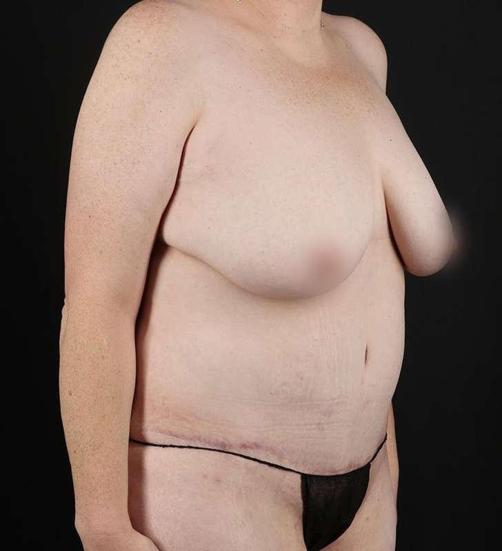Abdominoplasty (Tummy Tuck) Before & After Patient #948
