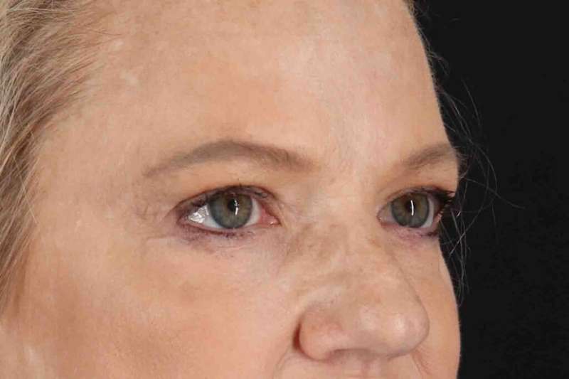 Brow Lift Before & After Patient #4854