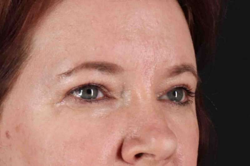 Brow Lift Before & After Patient #4865