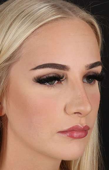 Brow Lift Before & After Patient #4876