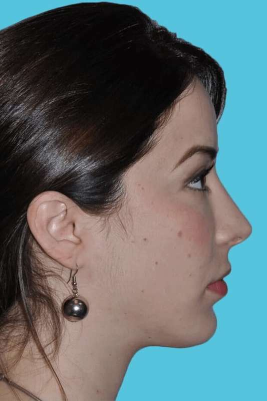 Chin Surgery Before & After Patient #4928