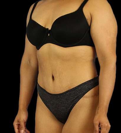 Abdominoplasty (Tummy Tuck) Before & After Patient #601