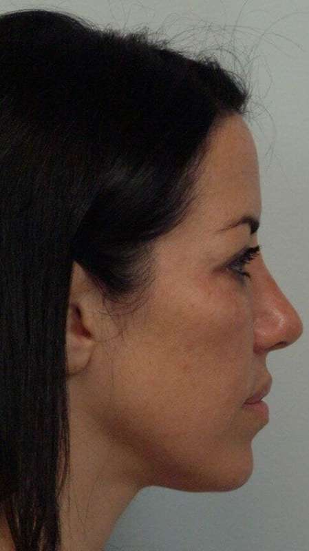 Chin Surgery Before & After Patient #4936