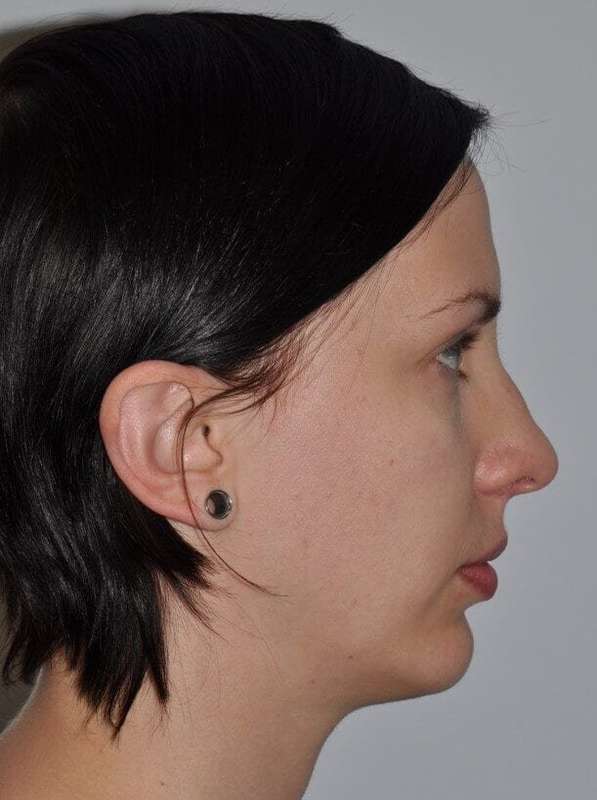 Chin Surgery Before & After Patient #4944