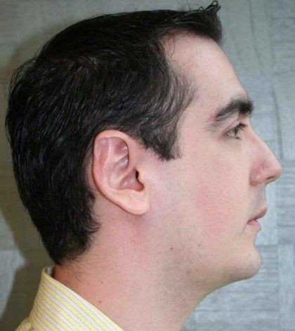 Chin Surgery Before & After Patient #4949