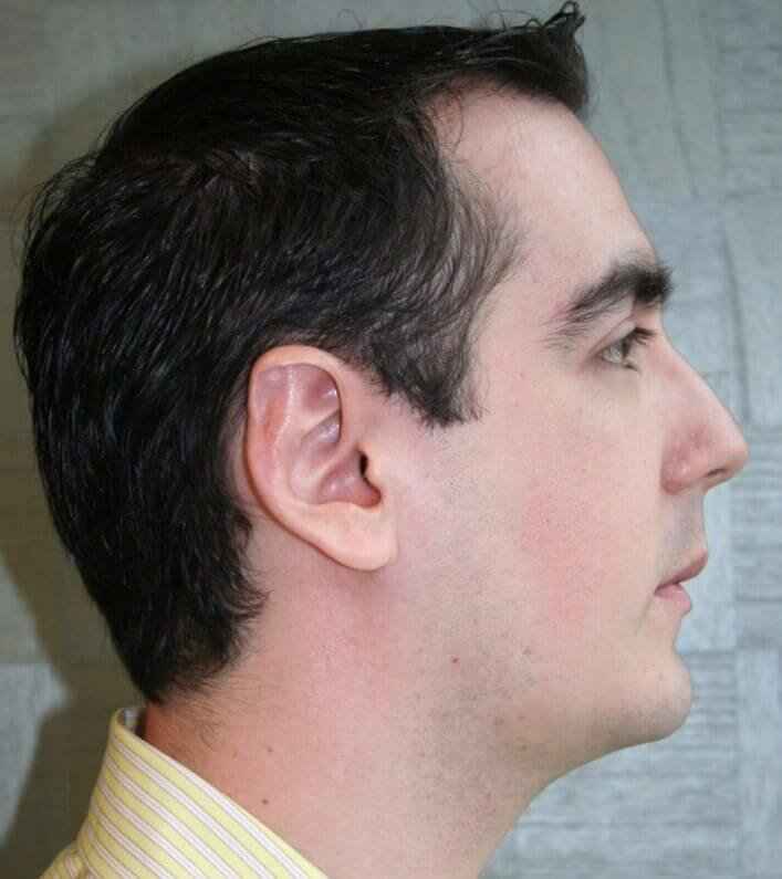 Chin Surgery Before & After Patient #4949