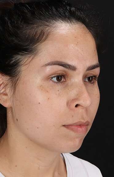 Cosmetic Injectables Before & After Patient #4990