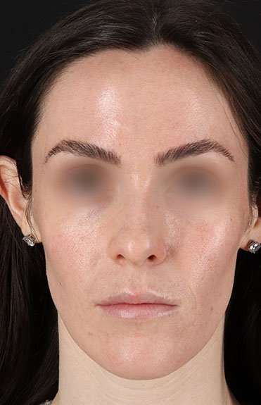 Cosmetic Injectables Before & After Patient #5016