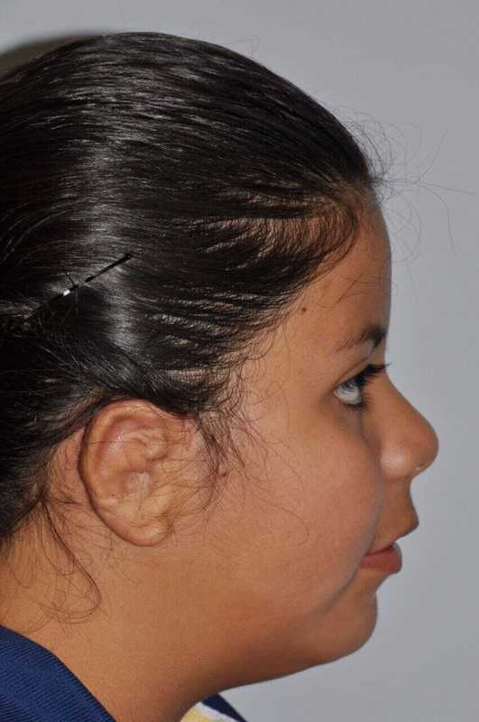Ear Reconstruction / Microtia Before & After Patient #5031