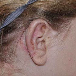 Ear Reconstruction / Microtia Before & After Patient #5045
