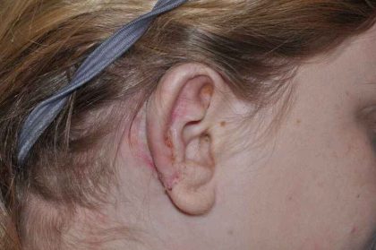 Ear Reconstruction / Microtia Before & After Patient #5045