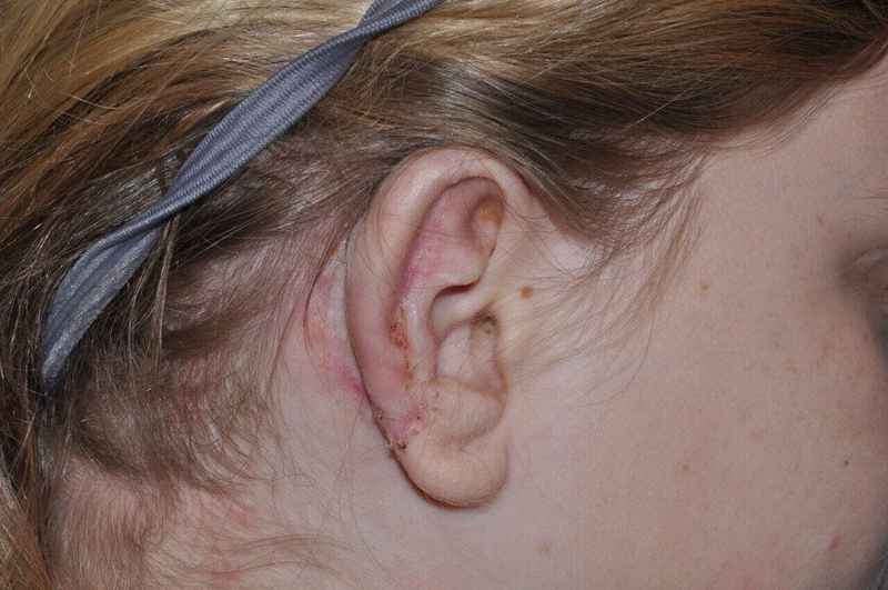 Ear Reconstruction / Microtia Before & After Patient #5045