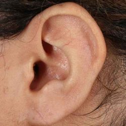Earlobe Repair Before & After Patient #5053