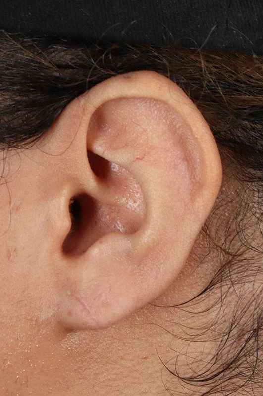Earlobe Repair Before & After Patient #5053