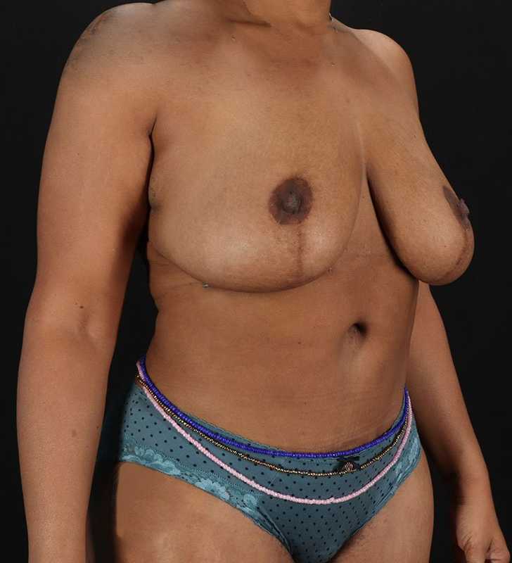 Abdominoplasty (Tummy Tuck) Before & After Patient #990