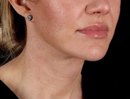 Facelift Before & After Patient #5185