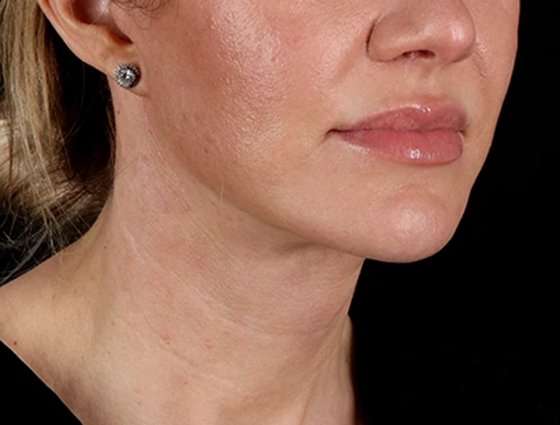 Facelift Before & After Patient #5185
