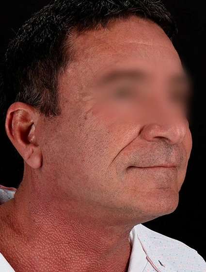 Facelift Before & After Patient #5207