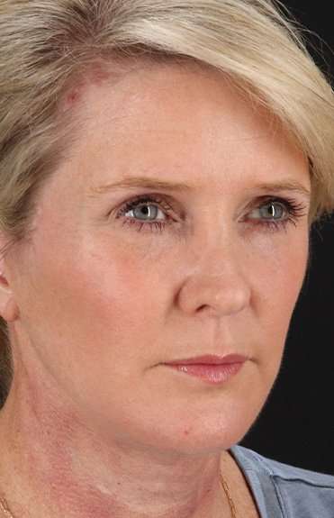 Facelift Before & After Patient #5229