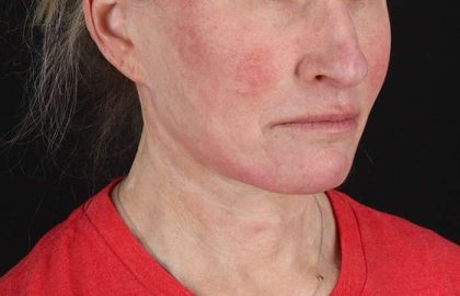 Facelift Before & After Patient #5240