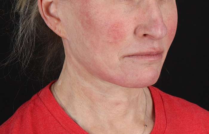 Facelift Before & After Patient #5240