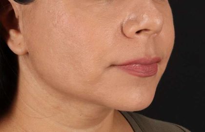 Facelift Before & After Patient #5251