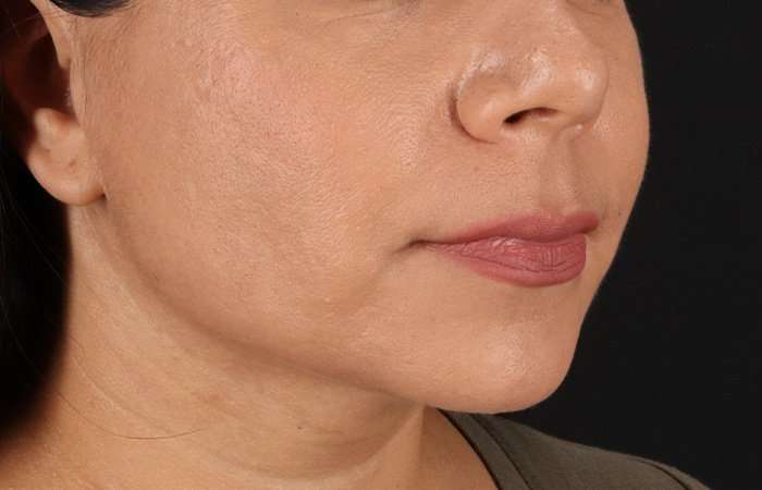 Facelift Before & After Patient #5251