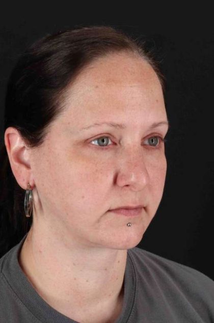 Facelift Before & After Patient #5273